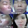 eska group batam eska aesthetic clinic & medispa 1-skin-resurfacing-refining-pores